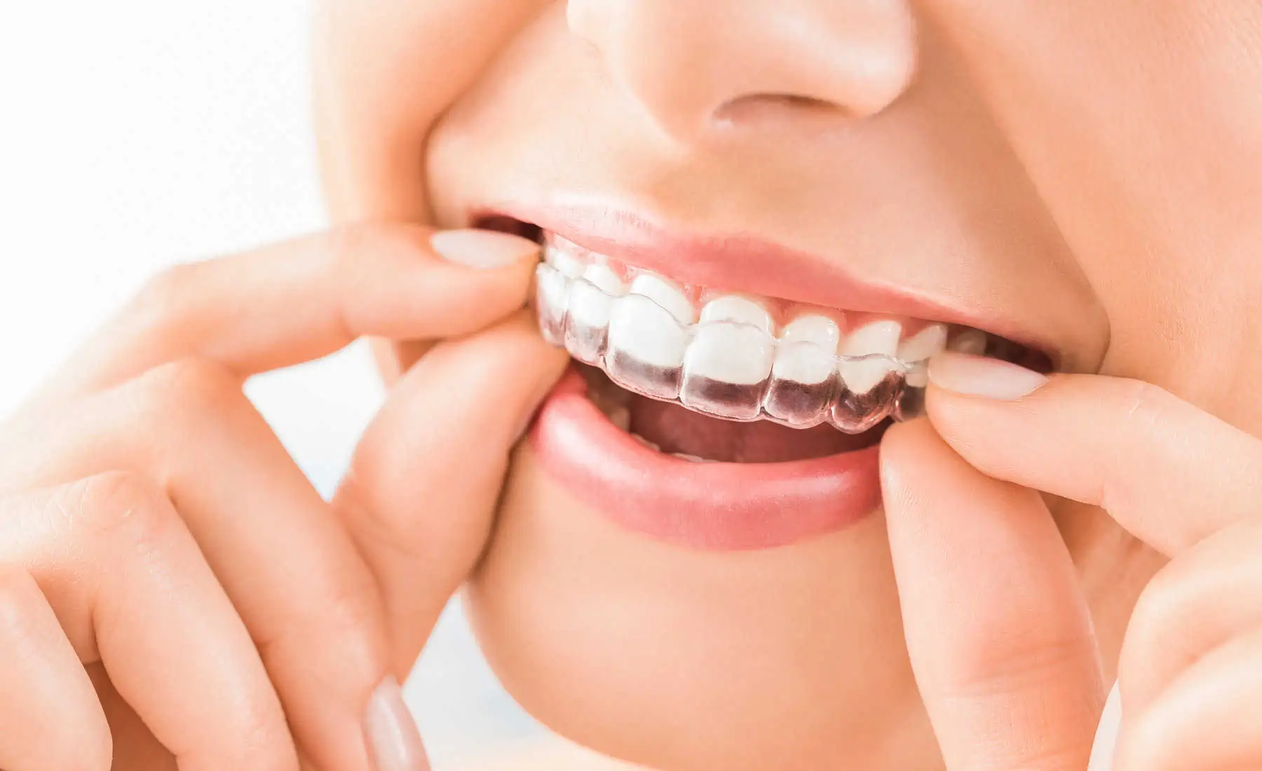 Close-up of a clear aligner being placed on teeth